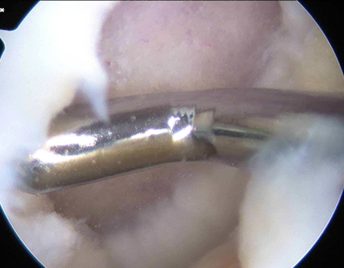 Chondral Lesion Post ACL Injury